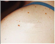 freckles shoulder - before.jpg (12355 bytes)