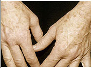 hands age spots - after.jpg (19323 bytes)