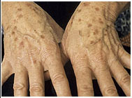 hands age spots - before.jpg (19034 bytes)
