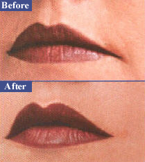 Vermilion lip border, befoe & after.jpg (38730 bytes)