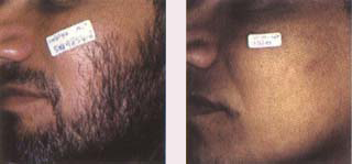 beard hair removal