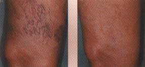 varicose popliteal spider vein removal