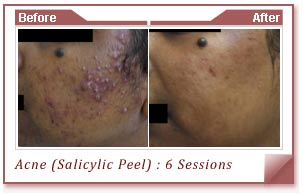 Acne Scars Treatment In Delhi