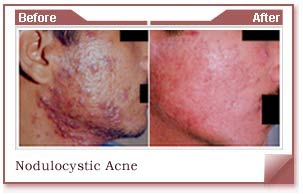 acne scars removal