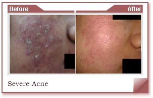 acne scar removal