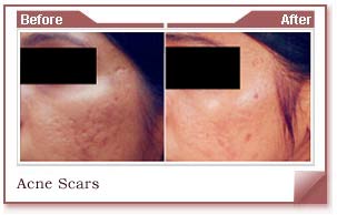 acne scar and spots removal