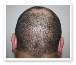 Consultation for Hair Loss