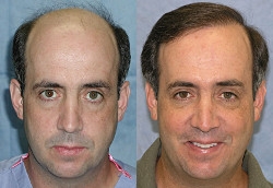 Robotic hair Transplant in Delhi and FUE Hair Transplant