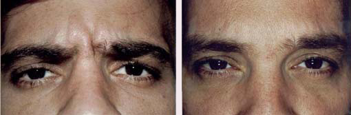 bottox-eyebrow lines 1.jpg (13713 bytes)