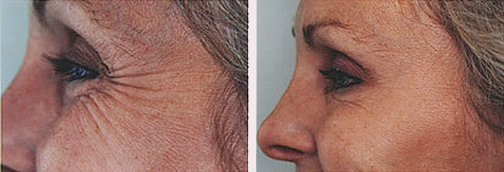 crows feet 1.jpg (38452 bytes)