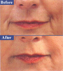 Oral commissures lines, before & after.jpg (38383 bytes)