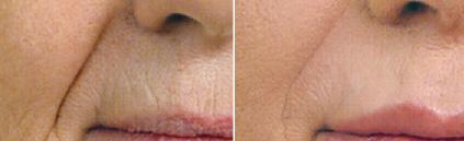 juvederm