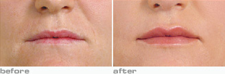 juvederm