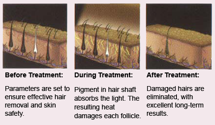 laser hair removal treatment
