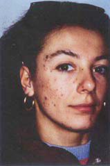 acne1-before.jpg (8895 bytes)
