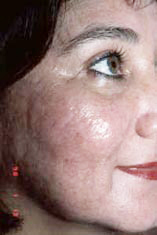 acne3-after.jpg (12599 bytes)