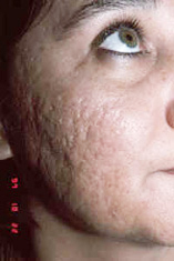 acne3-before.jpg (19844 bytes)