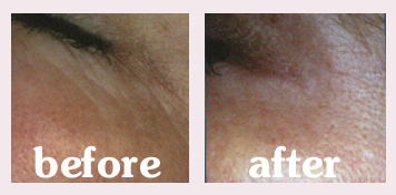 Wrinkles-corner of eye.jpg (34962 bytes)
