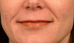 Before Radiesse - Nasolabial Fold