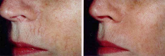capillaries around lips.jpg (12915 bytes)