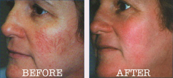 rosacea 1.JPG (26243 bytes)