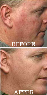 rosacea-man.jpg (23909 bytes)