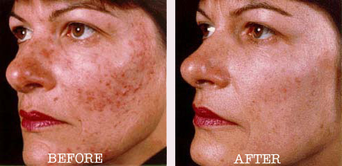 rosacea-woman.jpg (47151 bytes)