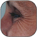Botox Injections