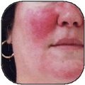 Rosacea Treatment
