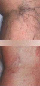 varicose bigger spider vein removal