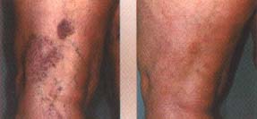 varicose blotches spider vein removal