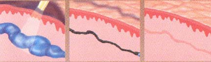 varicose spider vein removal