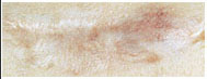 scar - after.jpg (10321 bytes)
