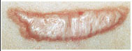 scar - before.jpg (10552 bytes)