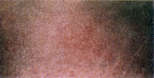 stretchmark-after.jpg (2262 bytes)
