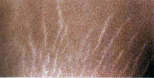 stretchmark-before.jpg (2440 bytes)