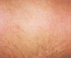 stretchmark2-before.jpg (49970 bytes)