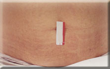 stretchmark3-abdomen-after.jpg (5675 bytes)