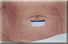 stretchmark3-abdomen-before.jpg (6146 bytes)