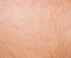 stretchmarks2-after.jpg (47123 bytes)