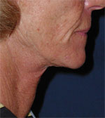 Titan Chin After Picture