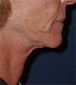Titan Chin Before Picture