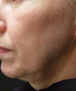 Titan Jowel Before Picture