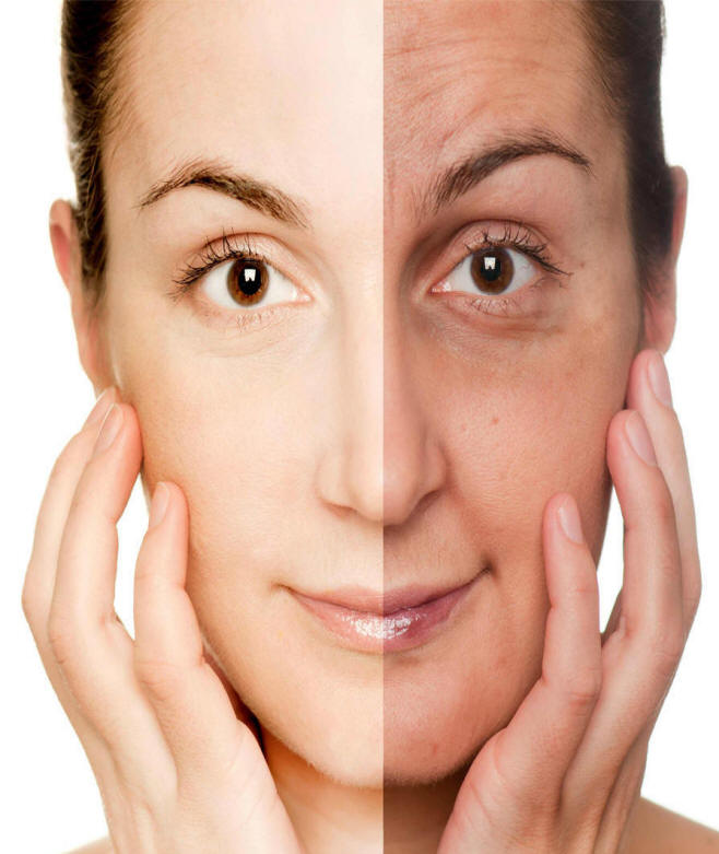 Chemical Peels Delhi