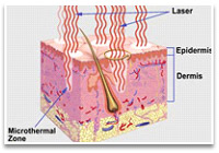 acne skin treatment