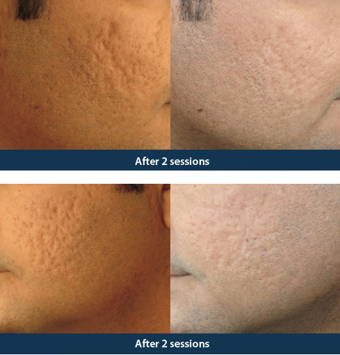 Acne Treatment Delhi