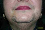 LASER Hair Removal by using Medio shoer High Power Diode Laser by New Look Laser Clinic