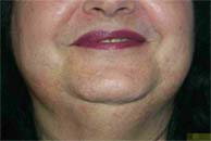 LASER Hair Removal by using Medio shoer High Power Diode Laser by New Look Laser Clinic