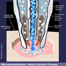 Microdermabrasion Delhi