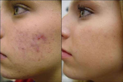 Microdermabrasion Delhi